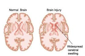 Traumatic Brain Injury doctor in Rewari