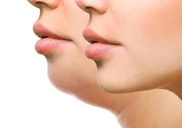 Double Chin Removal in Gurgaon