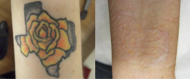 Tattoo Removal doctor in Gurgaon, India