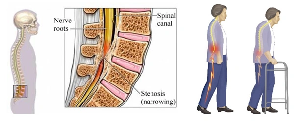 keyhole spine Tethered Cord surgery in gurgaon