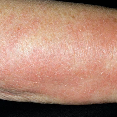 skin rashes treatment