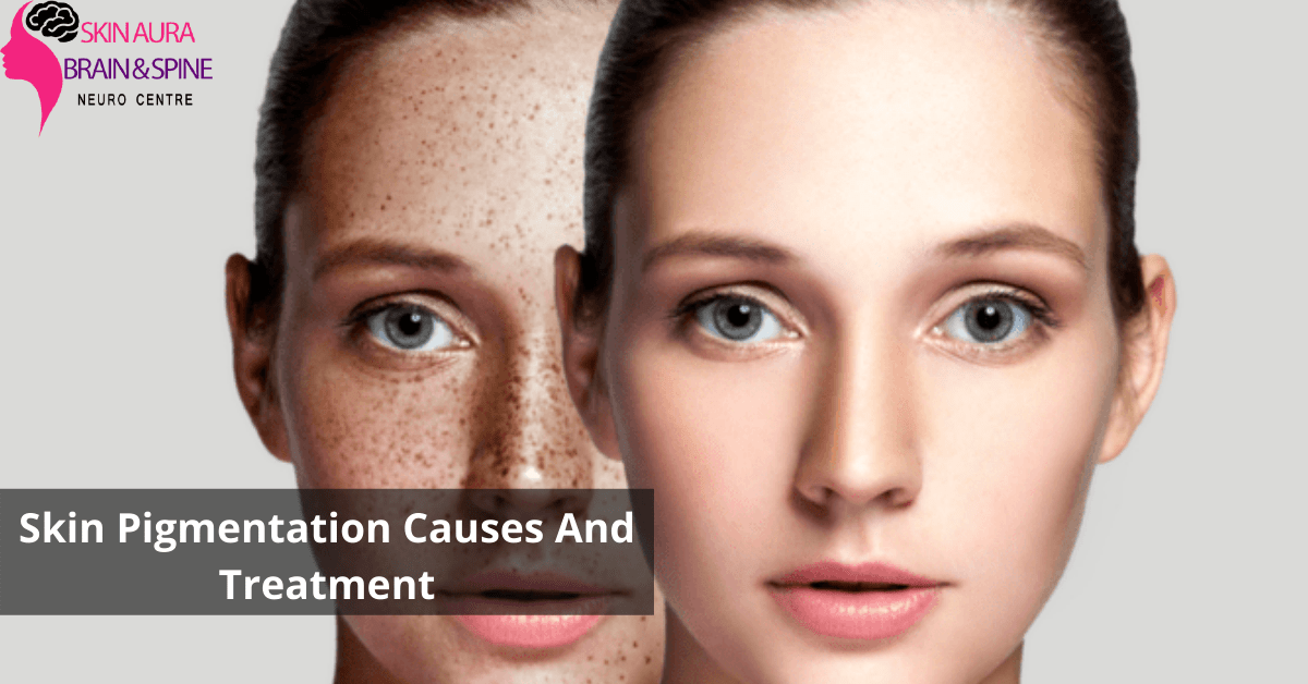 Skin Pigmentation Causes And Treatment