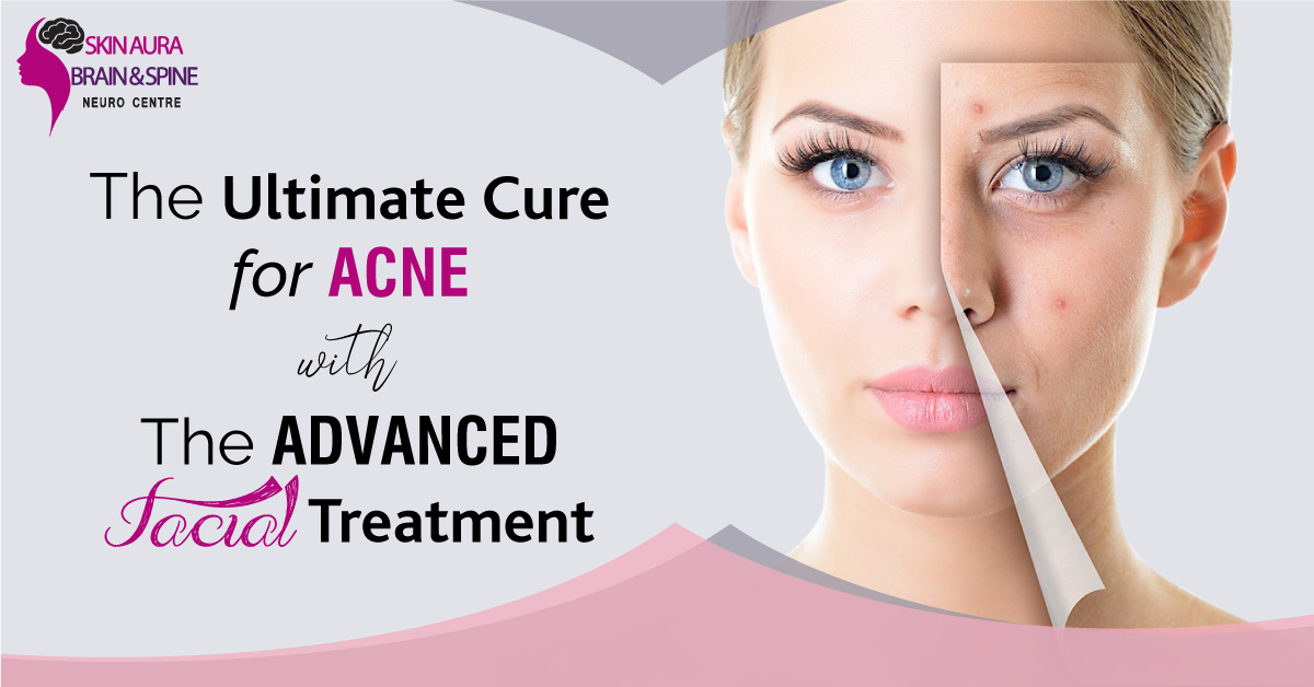 Acne treatment with advance facial treatment