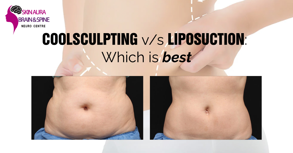 coolscultping or liposuction Treatment