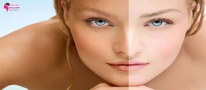 patchy skin best doctor for pigmentation in gurgaon