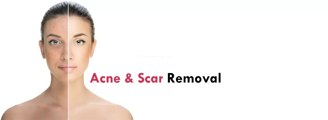 Acne & Scar Laser Treatment Clinic Gurgaon, India