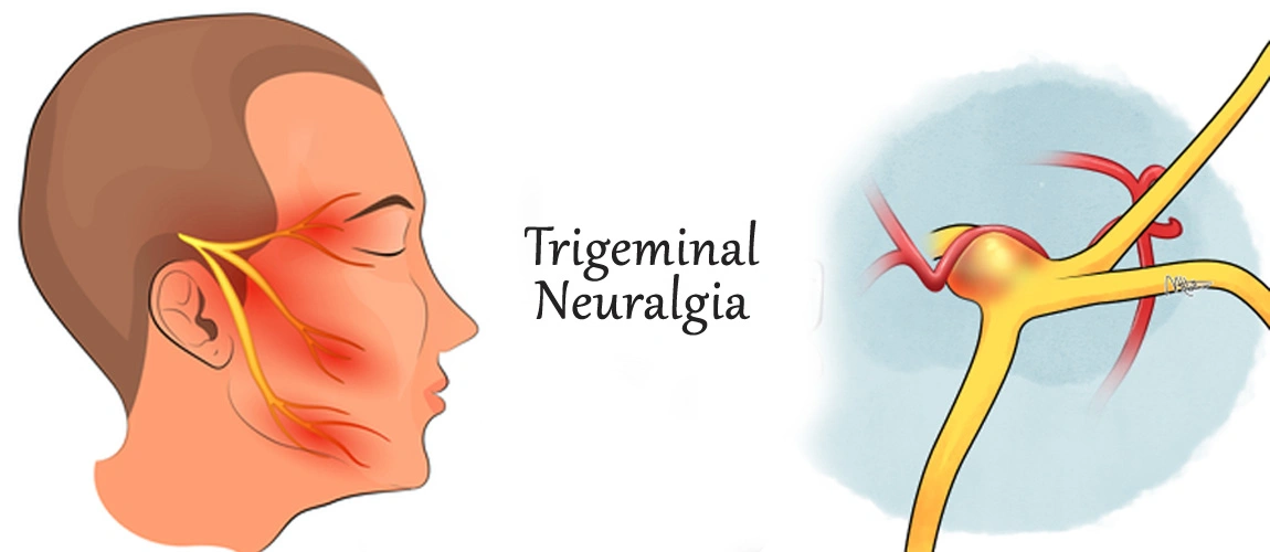 Trigeminal Neuralgia Clinic Gurgaon, India