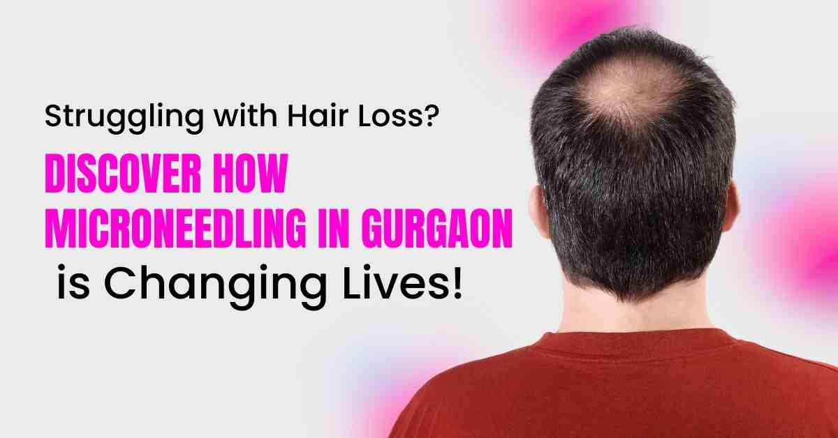 You are currently viewing Microneedling Treatment in Gurgaon – A Breakthrough Solution for Hair Loss & Hair Regrowth