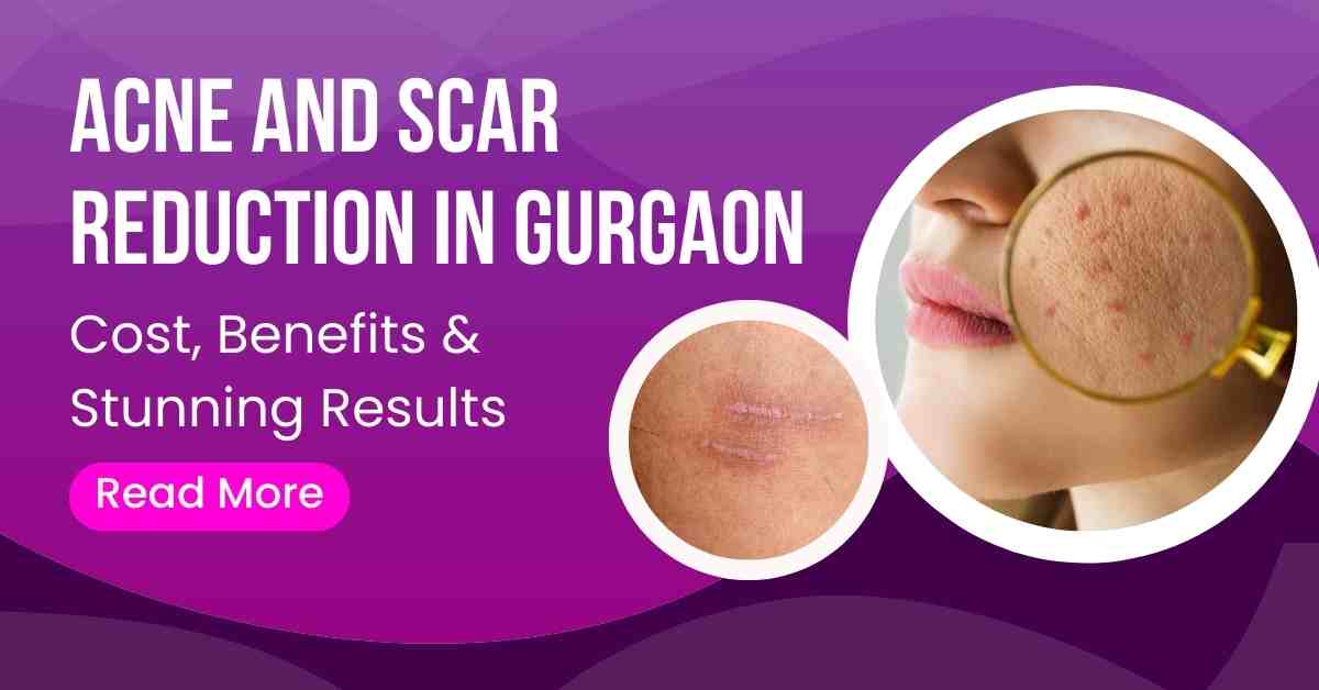 Read more about the article Acne and Scar Reduction in Gurgaon: Cost, Benefits & Stunning Results