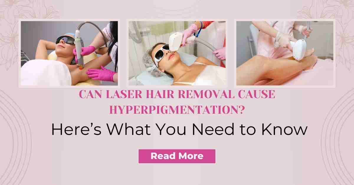 You are currently viewing Can Laser Hair Removal Cause Hyperpigmentation