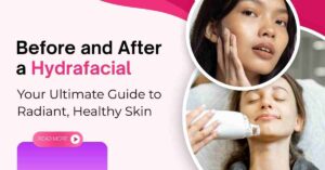 Read more about the article Before and After a Hydrafacial