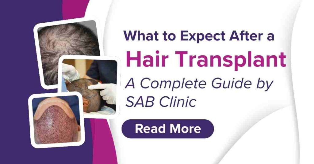 What to Expect After a Hair Transplant