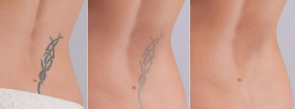 Laser Tattoo Removal
