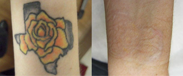 Laser Tattoo Removal in Gurgaon