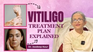 Vitiligo Treatment