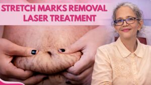 Stretch Marks Removal Laser Treatment