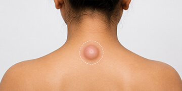 Cyst and Lipoma Removal Treatment in Gurgaon