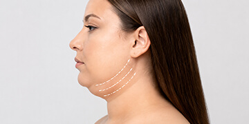 Double Chin Treatment in Gurgaon