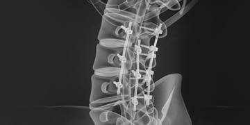 Lumbar Decompression Spine Surgery in Gurgaon