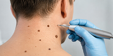 Mole Warts and Skin Tags Removal Treatment in Gurgaon