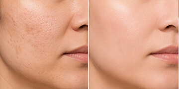 Scar Revision Treatment in Gurgaon