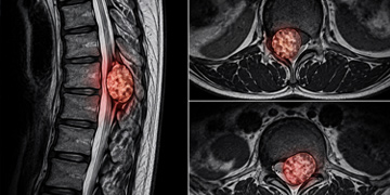 Spine Tumor Treatment in Gurgaon