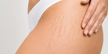 Stretch Marks Treatment in Gurgaon
