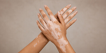Vitiligo Surgery Treatment in Gurgaon