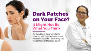 Woman with facial pigmentation and melasma patches consulting dermatologist in Gurgaon