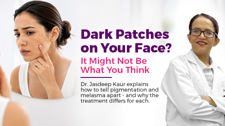 Woman with facial pigmentation and melasma patches consulting dermatologist in Gurgaon