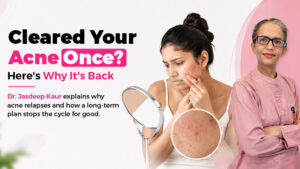 Woman examining recurring acne breakout on face in Gurgaon clinic