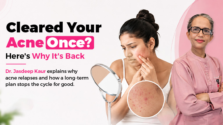 Woman examining recurring acne breakout on face in Gurgaon clinic